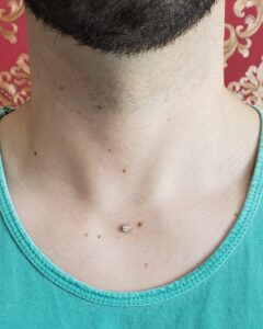 microdermal no pescoço