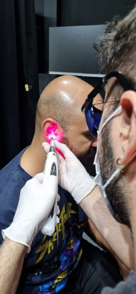 Laserterapia para piercings